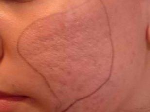 mesoterapia frazionale microneedle