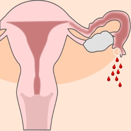 Mensile dopo il parto con l'allattamento al seno