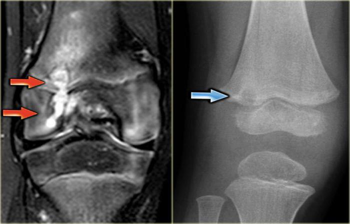 ascesso brodie tibia