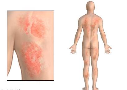 Allergia sul corpo. Come riconoscerlo e sconfiggerlo