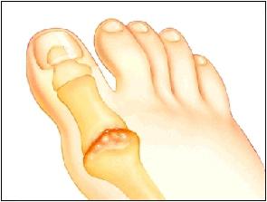 artrite ai piedi