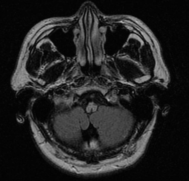 La malattia di Alessandro Modulo. Diagnosi. prospettiva