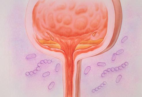 Malattie della vescica comuni nelle donne: sintomi, caratteristiche e segni