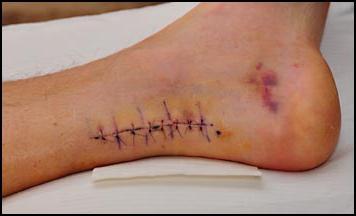 suture post-chirurgiche