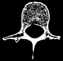 Ossa spugnose Schema dell'osso spugnoso. Struttura di un osso spugnoso