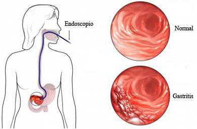 codice gatsrit erosivo xp secondo MKB 10