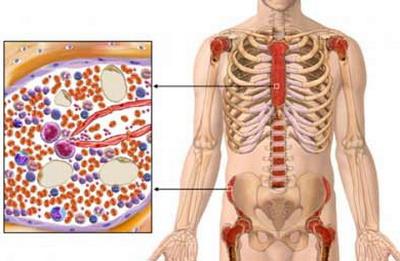 Segni di leucemia