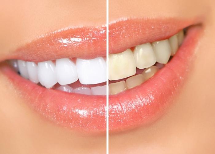 Un modo insolito per usare il perossido di idrogeno: sbiancamento dei denti