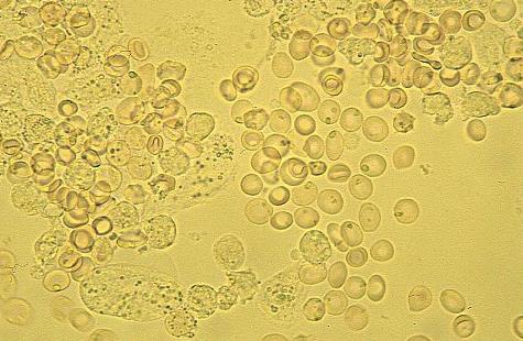 Che cosa è evidenziato da eritrociti nelle urine dei bambini