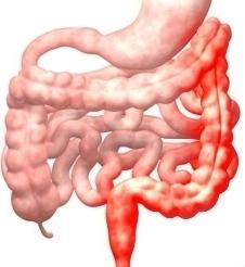 Colite ulcerosa di Crohn