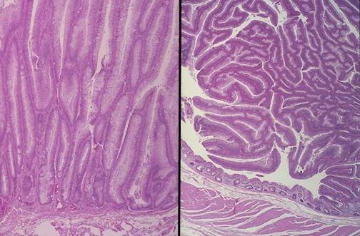 Adenoma tubulare con displasia di 1-2 gradi