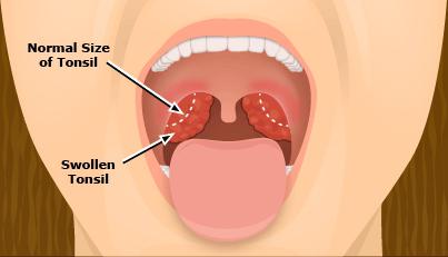 rimozione endoscopica di adenoidi