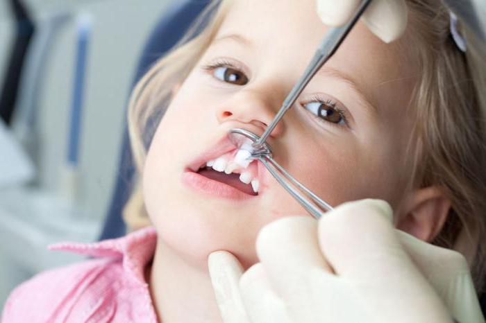 Rimozione dei denti da latte nel bambino: accetto o no?