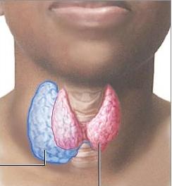 gozzo nodulare della tiroide 