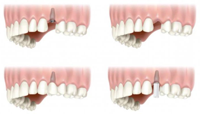 Denti artificiali: tipi e caratteristiche